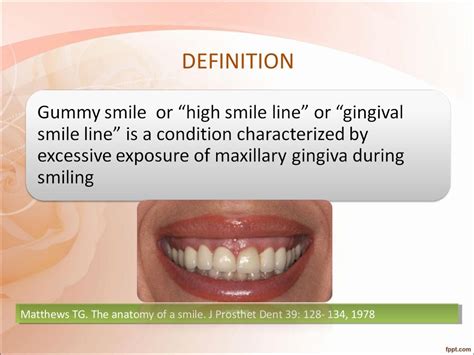 Differential Diagnosis And Management Of Gummy Smile