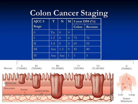 Stages Of Colorectal Cancer