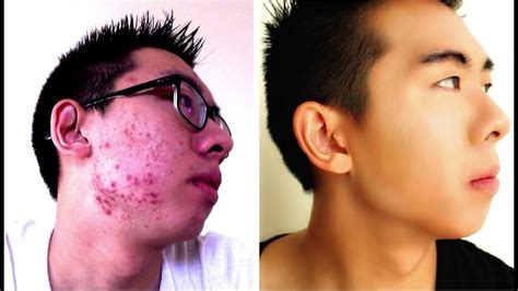 How To Get Rid Of Acne And Acne Scars For Men Youtube