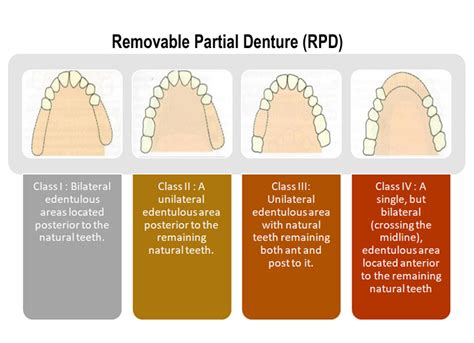 Removable Partial Denture Rpd Focus Dentistry