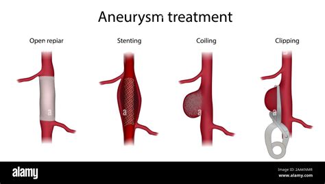 Aneurysm Treatment Illustration Comparison Of Clipping Open Surgery