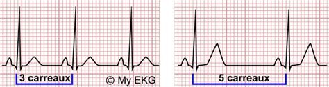 Rythme Sinusal Normal Comment Le Reconnaître Sur Un électrocardiogramme
