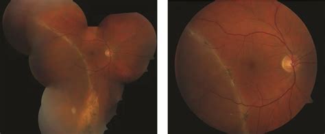 Chronic Retinal Detachment American Academy Of Ophthalmology