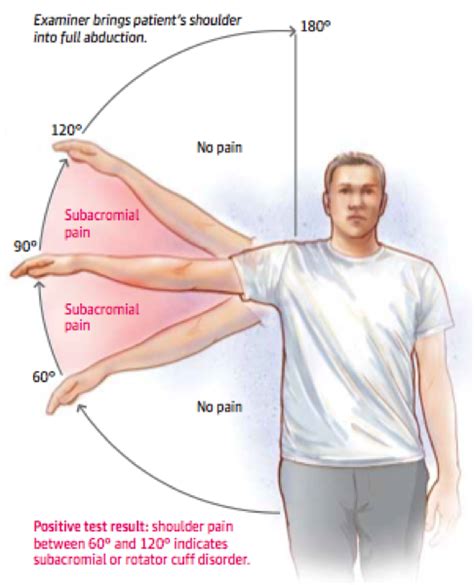 Subacromial Shoulder Impingement Syndrome