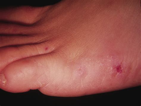 How To Detect And Treat Pruritus