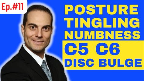 Ep11 C5 C6 Disc Bulge Posture And Arm Tingling Numbness Ask Dr