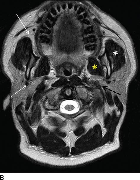The Glands Salivary Thyroid And Parathyroid Imaging Radiology Key