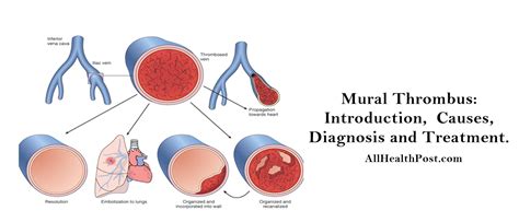 Mural Thrombus Introduction Causes Diagnosis Treatment