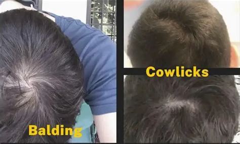 Cowlick Or Balding Explaining The Major Differences Stages Of Balding