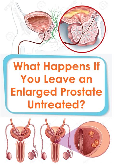Signs Of An Enlarged Prostate And How It Can Affect Your Sex Life Hot Sex Picture