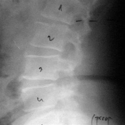 Pdf Lumbar Spinal Chondroma Presenting With Radiculopathy Case Report