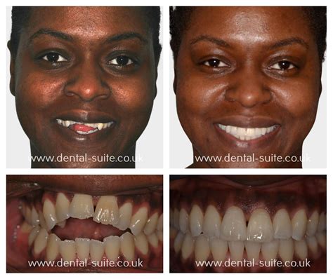 Damon Braces Before And After Photos Dental Suite Nottingham