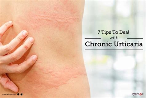 7 Tips To Get Rid Of Chronic Urticaria Or Hives By Dr Deepti