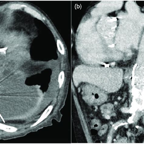 A Initial Contrast Enhanced Computed Tomography Ct Image Axial