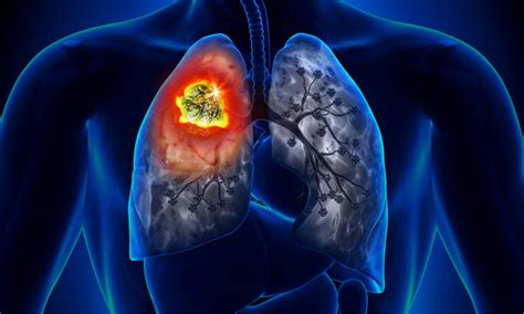 Atezolizumab After Chemotherapy In Resected Non Small Cell Lung Cancer