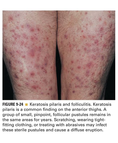 Tangs Clinical Tcm On Twitter These Red Spots Are Not Eczema They