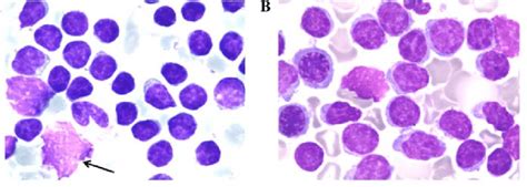 Case 2 A Peripheral Blood Smear Revealed Lymphocytosis With 16