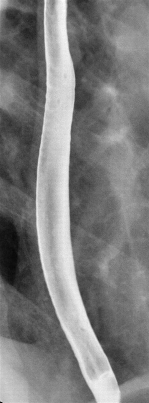 The Small Caliber Esophagus Radiographic Sign Of Idiopathic