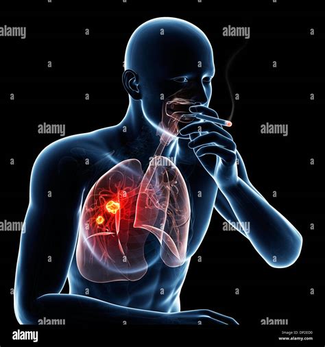 Lung Cancer Due To Smoking Artwork Stock Photo 65208780 Alamy