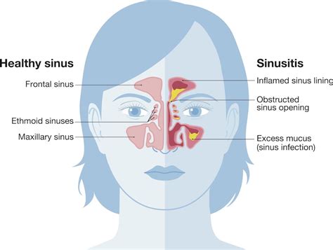 Sinus Infection Symptoms And Treatment Houston Tx