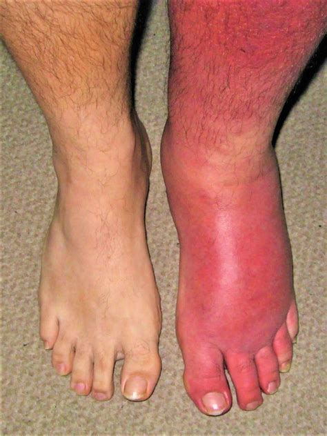 Bacterial Cellulitis Skin Infection Hot Sex Picture