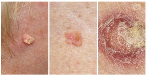 Skin Cancer Diagnosis Guide With Cancerous Mole And Skin Tag Pictures