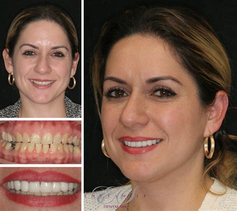 Cosmetic Dentistry Smile GalleryEnvy Smile Dental Spa