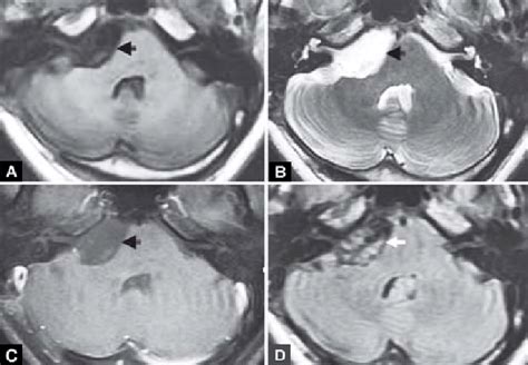 A To D Cerebellopontine Angle Epidermoid Cyst A Axial T1 Weighted