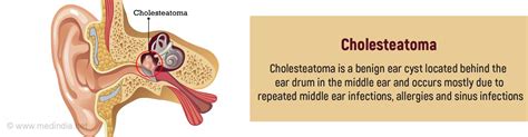 Cholesteatoma Cyst In Middle Ear Benign Ear Cyst