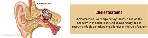 Ear Pain As Related To Benign Ear Cyst Or Tumor Pictures