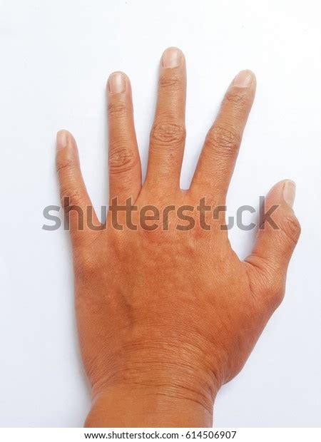 Urticaria On Hand Skin Stock Photo 614506907 Shutterstock