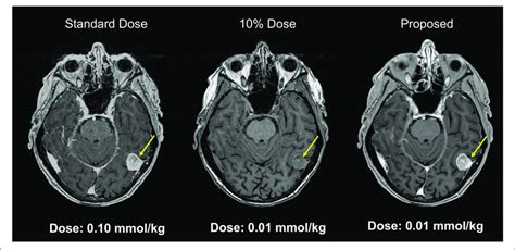 Example Of Low Dose Contrast Enhaced Mri Results From A Deep Network