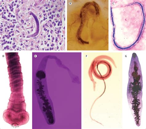 Helminths In Organ Transplantation The Lancet Infectious Diseases