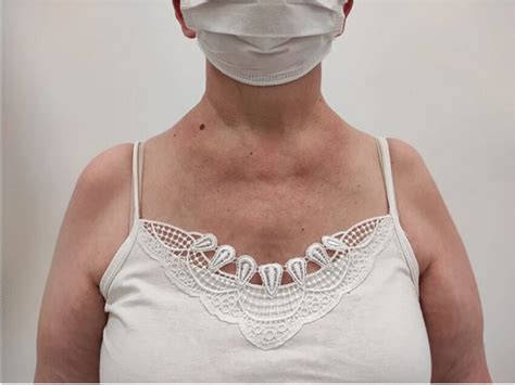 Physical Examination Showed A Photosensitive Lupus Rash On The Neck And