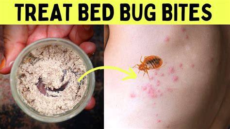 How To Get Rid Of Bed Bug Bites Overnight