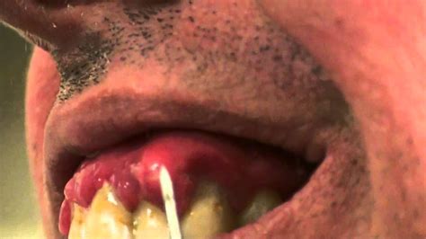 Lancing An Abscess Are Home Treatments Good Or Bad For Dental Abscess