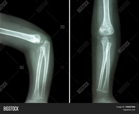 Film X Ray Child S Elbow Normal Image And Photo Bigstock