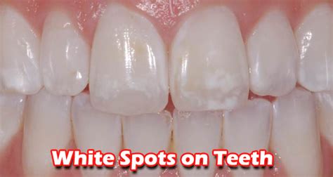 How To Get Rid Of White Blisters On Your Tongue 600 Red Blotches On