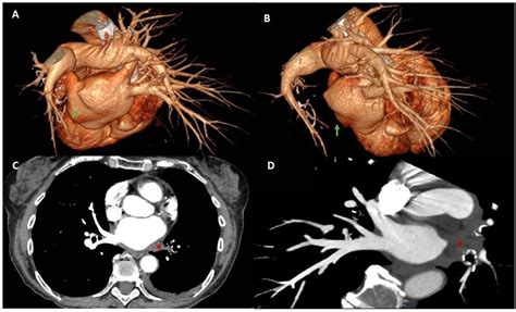 angiotac venas pulmonares ablacion auricula iaquierda Ocronos Editorial Científico Técnica