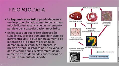 Sitio oficial del centro de miocardiopatía hipertrófica del hospital papa giovanni xxiii de bérgamo, uno de los hospitales más grandes y modernos. Miocardiopatía Hipertrófica. - YouTube