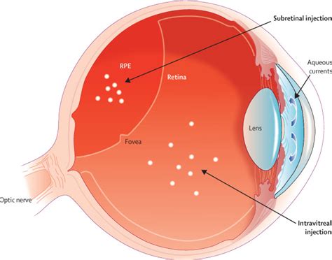 Benefits Of Gene Therapy For Both Eyes The Lancet