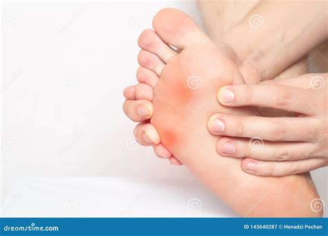 Red And Inflamed Skin On The Sole Of The Patient S Feet Pain From