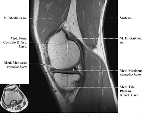 Figure 2 From Normal Mr Imaging Anatomy Of The Knee Semantic Scholar