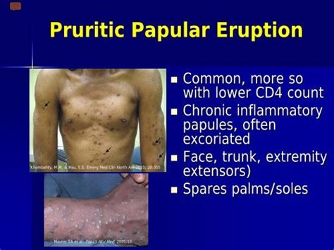 Pruritic Papular Eruption