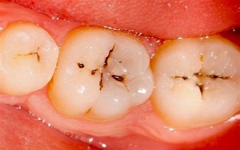 Tooth Decay Is Caused By Sugar And Bacteria Lorne Park Dental