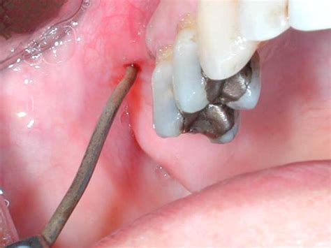 Endoscopic Surgical Treatment Of Chronic Maxillary Sinusitis Of Dental