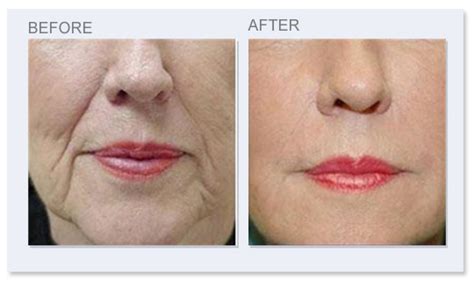 Tips For Finding The Best Wrinkle Reduction Options Suite 200 Med Spa