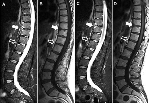 Vertebral Erosions Associated With Spinal Inflammation In Patients With