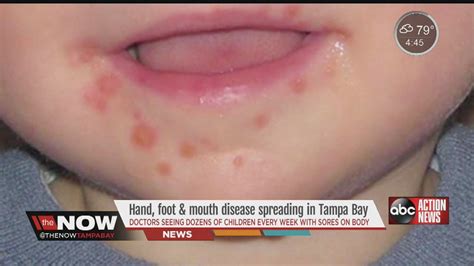 hand foot and mouth disease skin peeling