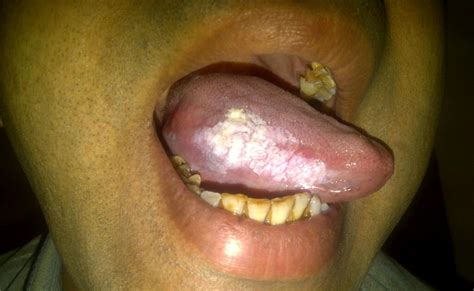 Ent Surgeons Blog Progression Of Leukoplakia Tongue Over Years